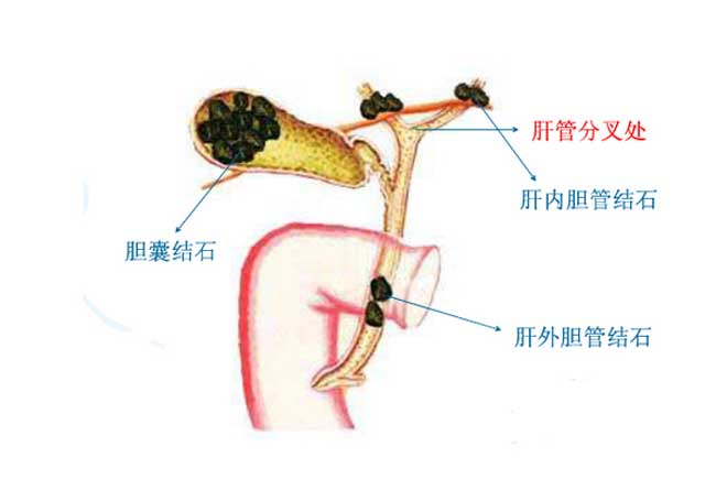 胆结石用药治疗可以吗 | 用药指南