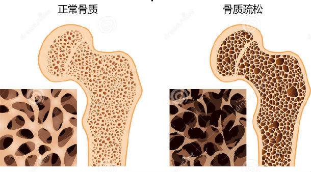 您知道骨质疏松有哪些症状吗？ 