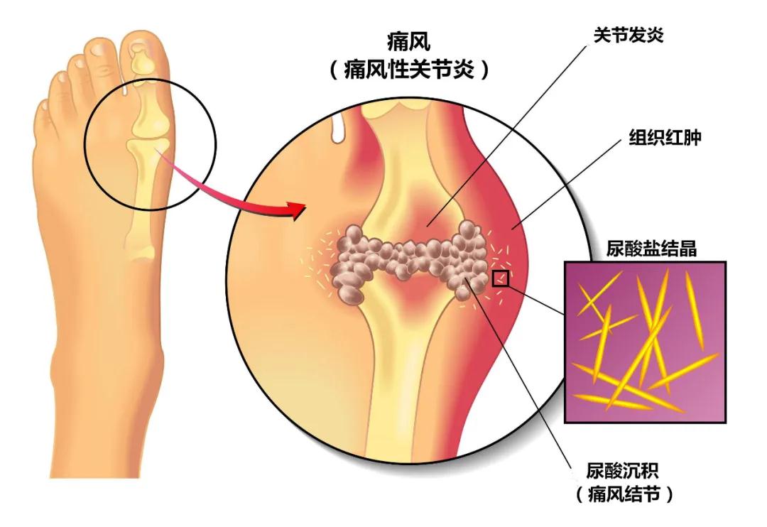 痛风用药最全攻略，100％干货