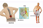 腰痛、腰腿痛就是腰椎间盘突出症吗？ | 健康资讯