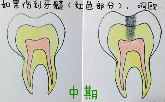 根管治疗