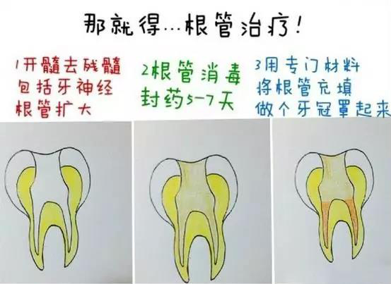 根管治疗