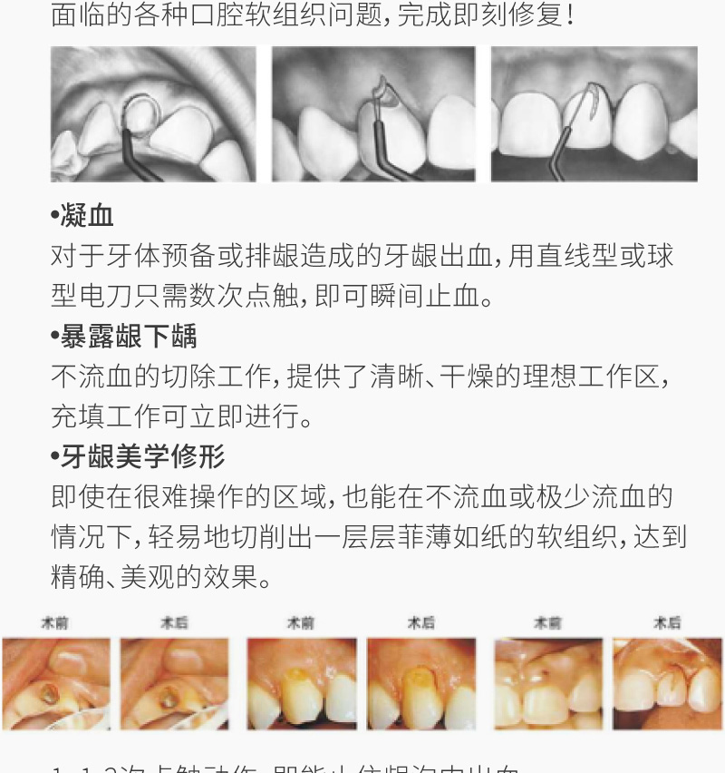 牙科高频电刀