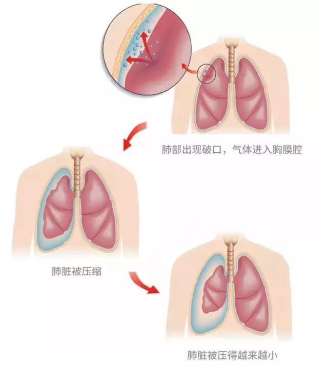 什么是气胸？