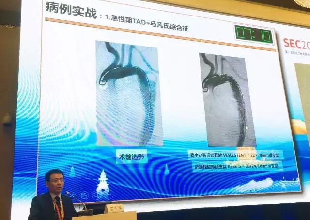 匠心良器 愈健未来—先健科技携外周血管产品参加SEC 2017 | 厂商资讯